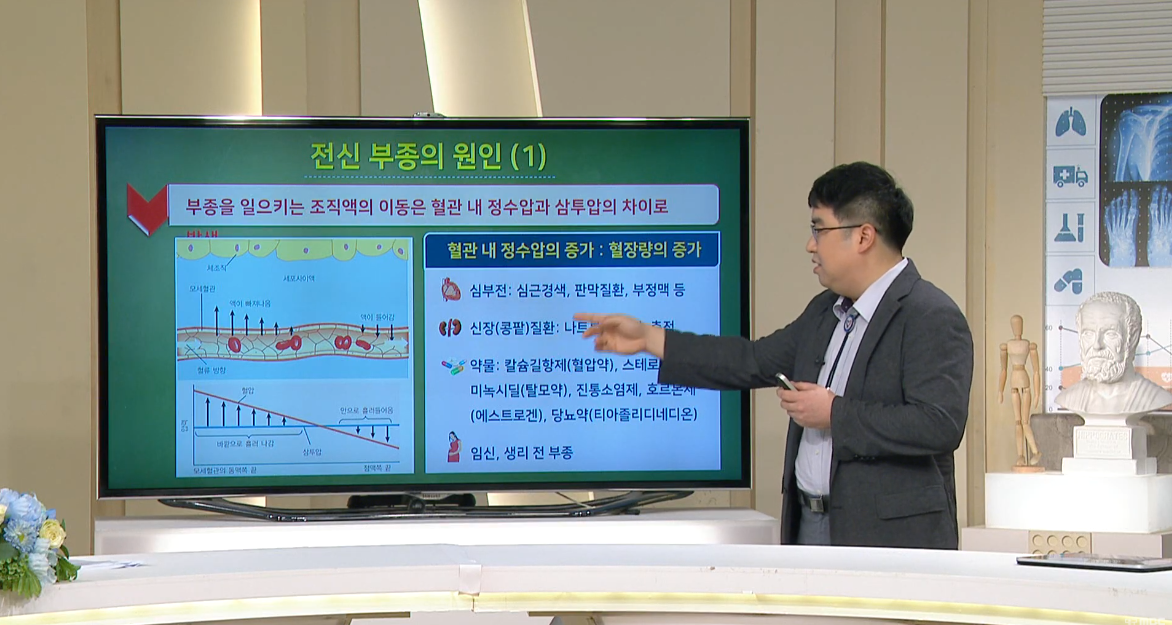 [대구MBC 약손] 부종의 원인과 진단-순환기내과 손장원 교수