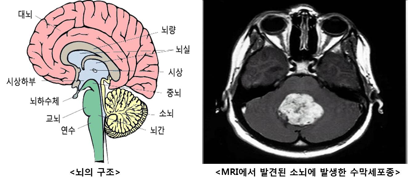 뇌구조 및 수막세포종