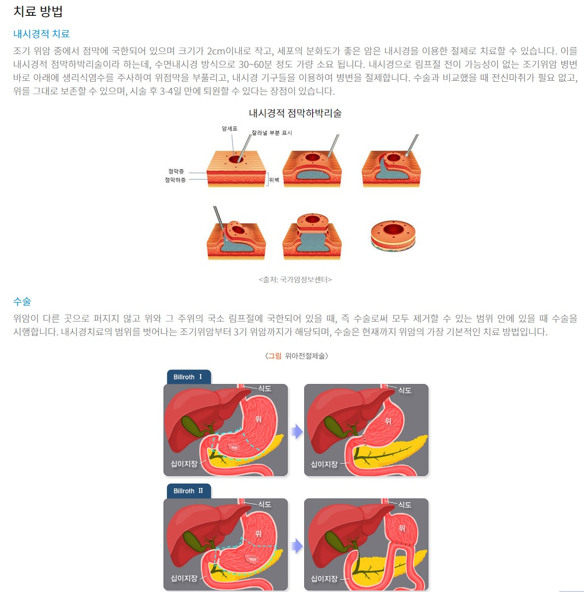 위암