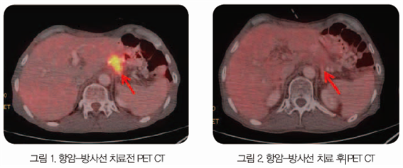 항암-방사선 치료 전/후 사진 PET-CT