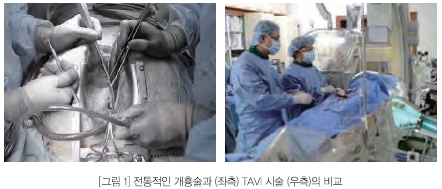 [그림1] 전통적인 개흉술과 TAVI시술의 비교