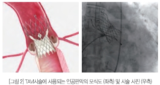 [그림2] TAVI시술에 사용되는 인공판막의 모식도 및 시술사진