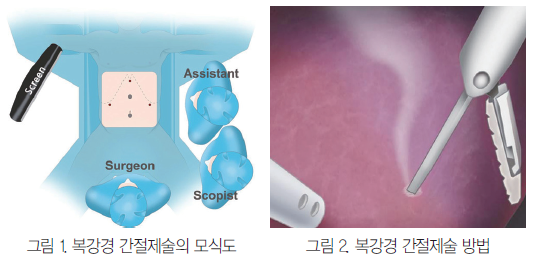 그림1 복강경 간절제술의 모식도, 그림2 복강경 간절제술 방법