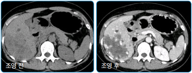 조영 전과 후 비교 사진
