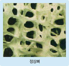 정상뼈