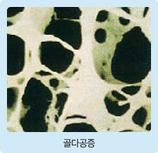 골다공증