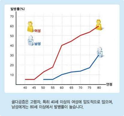 골다공증은 고령자, 특히 40세 이상의 여성에 압도적으로 많으며, 남성에게는 80세 이상에서 발병률이 높습니다.