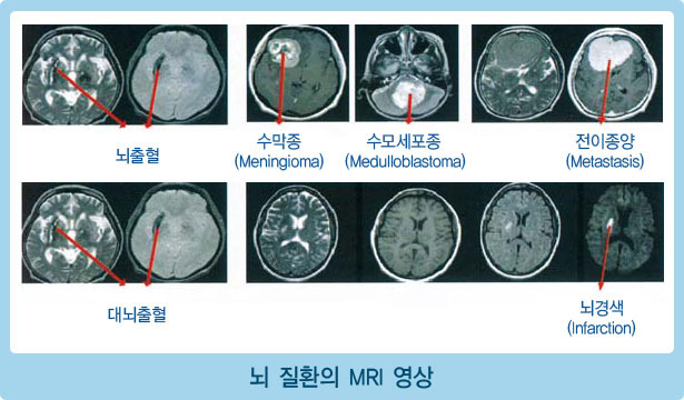 뇌출혈, 수막종(Meningioma), 수모세포종(Medulloblastoma), 전이종양(Metastasis), 대뇌출혈, 뇌경색(Infarction) 등의 뇌 질환의 MIR 영상