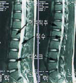 MRI 촬영 사진