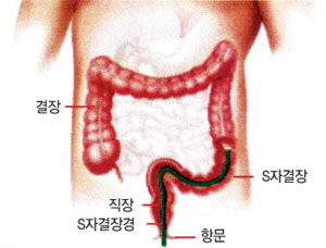결장, S자결장, 직장, S자결장경, 항문