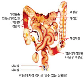 대장내시경 검사로 알 수 있는 질환들: 대장용종, 염증성대장질환(크론병), 장결핵, 대장암, 대장게실, 염증성대장질환(궤양성 대장염), 내치질, 외치질