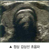 정상 갑상선 초음파