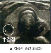 갑상선 종양 초음파