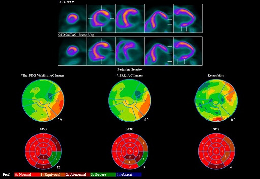 MYOCARDIAC PET/MR, FDG PET/MR 영상1