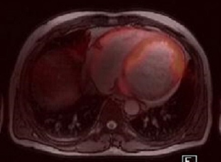 MYOCARDIAC PET/MR, FDG PET/MR 영상2