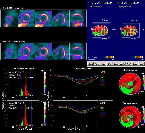 NH3 PET/MR(CARDIOMYOPATHY) 영상 1