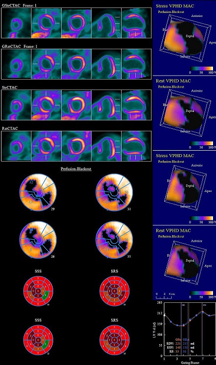 NH3 PET/MR(CARDIOMYOPATHY) 영상 2