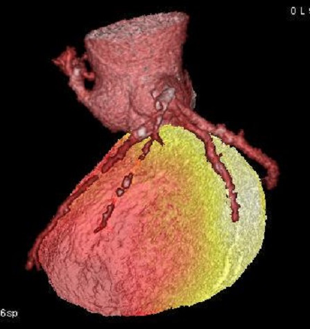 NH3 PET/MR(VIABLE/ISCHEMIA) 영상 1