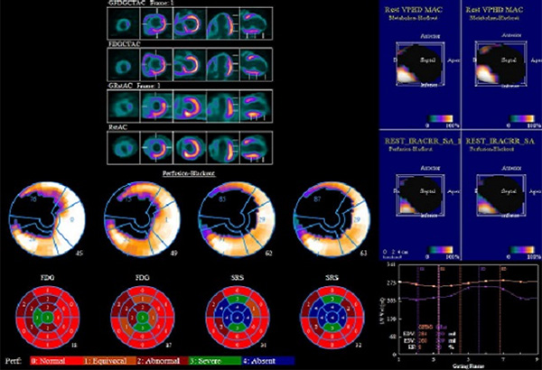 NH3 PET/MR(VIABLE/ISCHEMIA) 영상 2