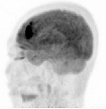 Brain PET/MR 영상 1
