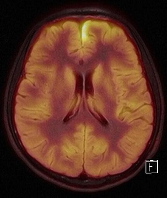 Brain PET/MR 영상 2
