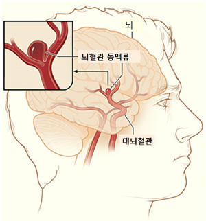 뇌혈관